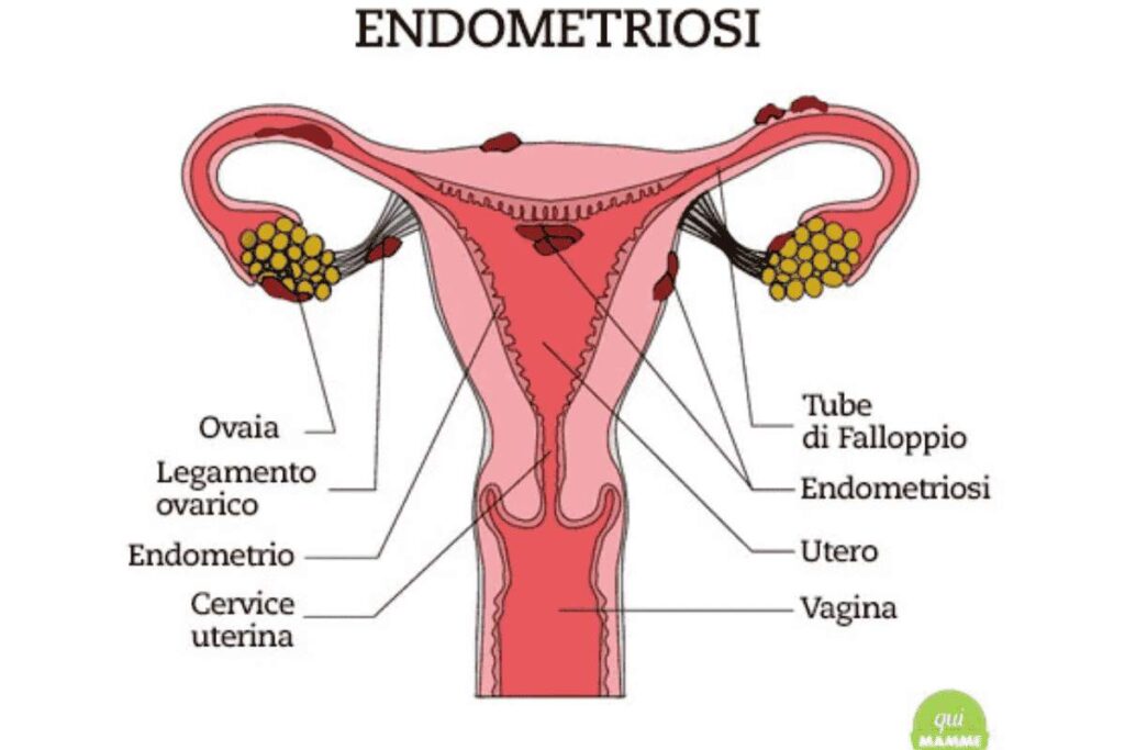 Ape e Corofar insieme per un incontro sull'endometriosi. Formazione specialistica per farmacisti: focus sull'endometriosi. Endometriosi, diagnosi e supporto: un evento per farmacisti. 